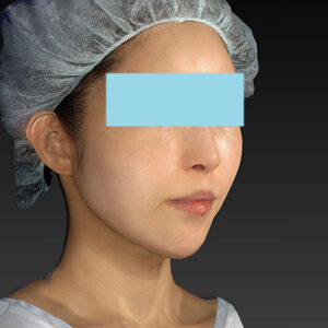 新宿ラクル美容外科クリニック　山本厚志　「アルテミスリフト」　手術後２ヶ月目　３月３０日