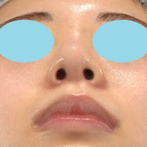 新宿ラクル美容外科クリニック　山本厚志　「貴族手術（鼻翼基部プロテーゼ）＋ 小鼻縮小+α法」　手術後2ヶ月目　３月３１日