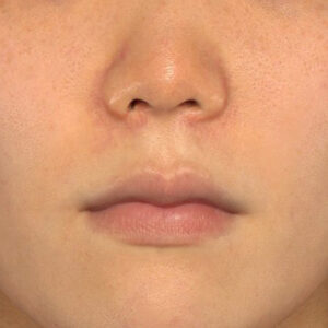 新宿ラクル美容外科クリニック　山本厚志　「猫手術（鼻唇角形成術）+ 貴族手術（鼻翼基部プロテーゼ）」　手術後２ヶ月目　３月１日