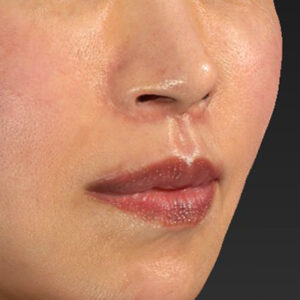 新宿ラクル美容外科クリニック　山本厚志　「外側人中短縮術（上口唇挙上術）+ 人中短縮術（リップリフト）＋口唇縮小」　手術後２ヶ月目　３月２８日