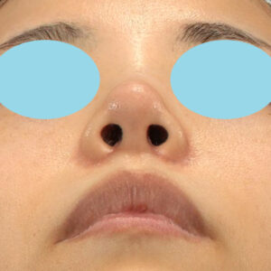 「耳介軟骨移植＋鼻尖縮小（close法）＋小鼻縮小+α」　新宿ラクル美容外科クリニック　２０代女性　手術後２ヶ月目　３月２９日