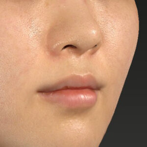 新宿ラクル美容外科クリニック　山本厚志　「猫手術（鼻唇角形成術）+ 貴族手術（鼻翼基部プロテーゼ）」　手術後３ヶ月目　４月１３日