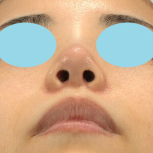 「耳介軟骨移植＋鼻尖縮小（close法）＋小鼻縮小+α」　新宿ラクル美容外科クリニック　２０代女性　手術後３ヶ月目　３月２９日