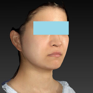 新宿ラクル美容外科クリニック　山本厚志　「ナチュラルフェイスリフト」「ライポライフ脂肪吸引（メーラーファット+ジョールファット）」　手術後３ヶ月目　３月２０日