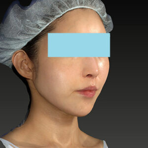 新宿ラクル美容外科クリニック　山本厚志　「アルテミスリフト」　手術後３ヶ月目　３月３０日