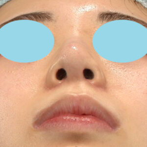 新宿ラクル美容外科クリニック　山本厚志　「貴族手術（鼻翼基部プロテーゼ）＋ 小鼻縮小+α法」　手術後３ヶ月目　４月１０日