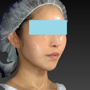 新宿ラクル美容外科クリニック　山本厚志　「アルテミスリフト」　手術後６ヶ月目　３月３０日