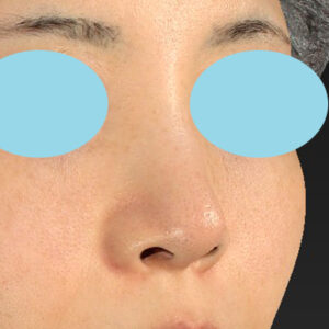 「耳介軟骨移植＋鼻尖縮小（close法）＋小鼻縮小+α」　新宿ラクル美容外科クリニック　２０代女性　手術前　３月２９日