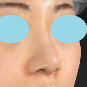 新宿ラクル美容外科クリニック　山本厚志　「貴族手術（鼻翼基部プロテーゼ）＋ 小鼻縮小+α法」　手術前　３月３１日