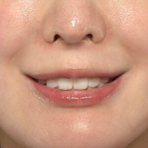 新宿ラクル美容外科クリニック　山本厚志　「貴族手術（鼻翼基部プロテーゼ）」　手術前　３月５日