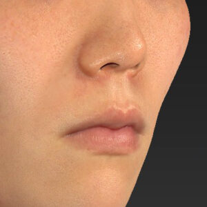 新宿ラクル美容外科クリニック　山本厚志　「猫手術（鼻唇角形成術）+ 貴族手術（鼻翼基部プロテーゼ）」　手術前　３月１日