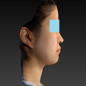 新宿ラクル美容外科クリニック　山本厚志　「ナチュラルフェイスリフト」「ライポライフ脂肪吸引（メーラーファット+ジョールファット）」　手術前　３月２０日