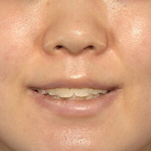 新宿ラクル美容外科クリニック　山本厚志　「猫手術（鼻唇角形成術）+ 貴族手術（鼻翼基部プロテーゼ）」　手術前　３月２５日