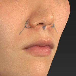 新宿ラクル美容外科クリニック　山本厚志　「猫手術（鼻唇角形成術）+ 貴族手術（鼻翼基部プロテーゼ）」　デザイン　３月１日