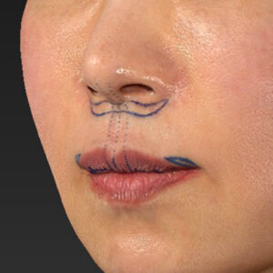 新宿ラクル美容外科クリニック　山本厚志　「外側人中短縮術（上口唇挙上術）+ 人中短縮術（リップリフト）＋口唇縮小」　デザイン　３月２８日