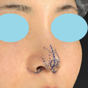 「耳介軟骨移植＋鼻尖縮小（close法）＋小鼻縮小+α」　新宿ラクル美容外科クリニック　２０代女性　デザイン　３月２９日