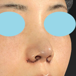 「耳介軟骨移植＋鼻尖縮小（close法）＋小鼻縮小+α」　新宿ラクル美容外科クリニック　２０代女性　手術直後　３月２９日