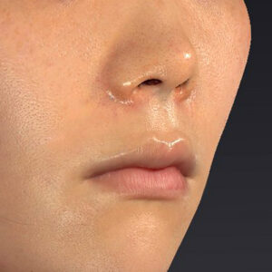 新宿ラクル美容外科クリニック　山本厚志　「猫手術（鼻唇角形成術）+ 貴族手術（鼻翼基部プロテーゼ）」　手術直後　３月１日