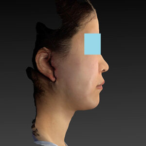 新宿ラクル美容外科クリニック　山本厚志　「ナチュラルフェイスリフト」「ライポライフ脂肪吸引（メーラーファット+ジョールファット）」　手術直後　３月２０日