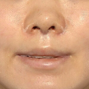 新宿ラクル美容外科クリニック　山本厚志　「猫手術（鼻唇角形成術）+ 貴族手術（鼻翼基部プロテーゼ）」　手術直後　３月２５日