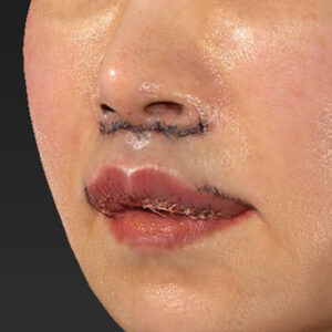 新宿ラクル美容外科クリニック　山本厚志　「外側人中短縮術（上口唇挙上術）+ 人中短縮術（リップリフト）＋口唇縮小」　手術直後　３月２８日