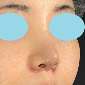 「耳介軟骨移植＋鼻尖縮小（close法）＋小鼻縮小+α」　新宿ラクル美容外科クリニック　２０代女性　手術後１週間目　３月２９日