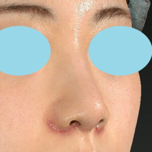 新宿ラクル美容外科クリニック　山本厚志　「貴族手術（鼻翼基部プロテーゼ）＋ 小鼻縮小+α法」　手術後１週間目　３月３１日