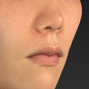 新宿ラクル美容外科クリニック　山本厚志　「猫手術（鼻唇角形成術）+ 貴族手術（鼻翼基部プロテーゼ）」　手術後１週間目　３月１日