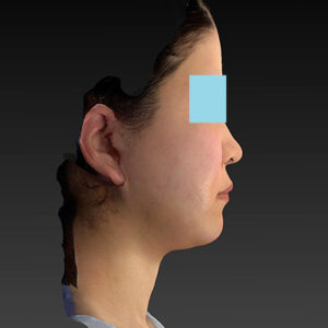 新宿ラクル美容外科クリニック　山本厚志　「ナチュラルフェイスリフト」「ライポライフ脂肪吸引（メーラーファット+ジョールファット）」　手術後１週間目　３月２０日