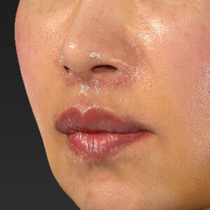 新宿ラクル美容外科クリニック　山本厚志　「外側人中短縮術（上口唇挙上術）+ 人中短縮術（リップリフト）＋口唇縮小」　手術後１週間目　３月２８日