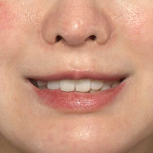 新宿ラクル美容外科クリニック　山本厚志　「貴族手術（鼻翼基部プロテーゼ）」　手術後１ヶ月目　３月５日