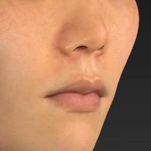 新宿ラクル美容外科クリニック　山本厚志　「猫手術（鼻唇角形成術）+ 貴族手術（鼻翼基部プロテーゼ）」　手術後１ヶ月目　３月１日