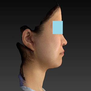 新宿ラクル美容外科クリニック　山本厚志　「ナチュラルフェイスリフト」「ライポライフ脂肪吸引（メーラーファット+ジョールファット）」　手術後１ヶ月目　３月２０日