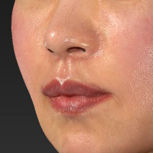 新宿ラクル美容外科クリニック　山本厚志　「外側人中短縮術（上口唇挙上術）+ 人中短縮術（リップリフト）＋口唇縮小」　手術後１ヶ月目　３月２８日