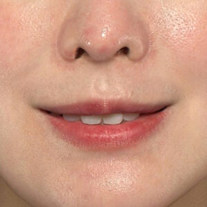 新宿ラクル美容外科クリニック　山本厚志　「貴族手術（鼻翼基部プロテーゼ）」　手術後２ヶ月目　３月５日