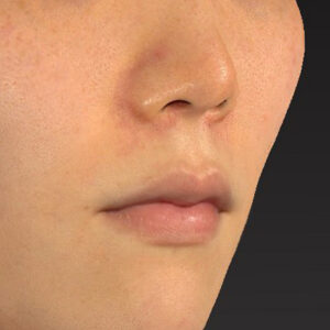 新宿ラクル美容外科クリニック　山本厚志　「猫手術（鼻唇角形成術）+ 貴族手術（鼻翼基部プロテーゼ）」　手術後２ヶ月目　３月１日