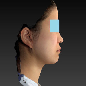 新宿ラクル美容外科クリニック　山本厚志　「ナチュラルフェイスリフト」「ライポライフ脂肪吸引（メーラーファット+ジョールファット）」　手術後２ヶ月目　３月２０日