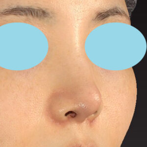 「耳介軟骨移植＋鼻尖縮小（close法）＋小鼻縮小+α」　新宿ラクル美容外科クリニック　２０代女性　手術後２ヶ月目　３月２９日