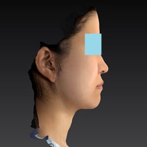 新宿ラクル美容外科クリニック　山本厚志　「ナチュラルフェイスリフト」「ライポライフ脂肪吸引（メーラーファット+ジョールファット）」　手術後３ヶ月目　３月２０日