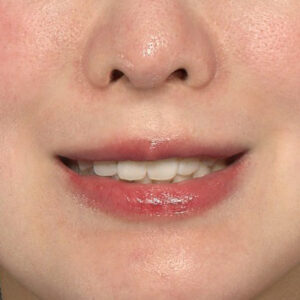 新宿ラクル美容外科クリニック　山本厚志　「貴族手術（鼻翼基部プロテーゼ）」　手術後３ヶ月目　４月７日