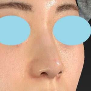 新宿ラクル美容外科クリニック　山本厚志　「貴族手術（鼻翼基部プロテーゼ）＋ 小鼻縮小+α法」　手術後３ヶ月目　４月１０日