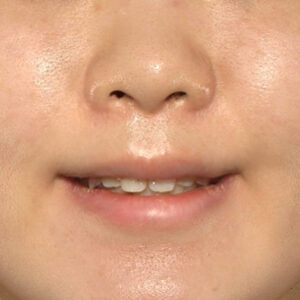 新宿ラクル美容外科クリニック　山本厚志　「猫手術（鼻唇角形成術）+ 貴族手術（鼻翼基部プロテーゼ）」　手術後３ヶ月目　４月１３日