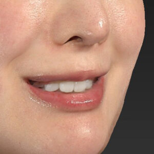 新宿ラクル美容外科クリニック　山本厚志　「貴族手術（鼻翼基部プロテーゼ）」　手術前　３月５日