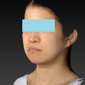 新宿ラクル美容外科クリニック　山本厚志　「ナチュラルフェイスリフト」「ライポライフ脂肪吸引（メーラーファット+ジョールファット）」　手術前　３月２０日