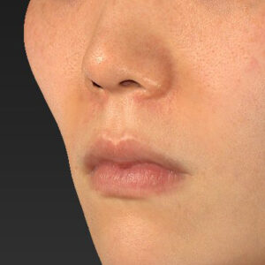 新宿ラクル美容外科クリニック　山本厚志　「猫手術（鼻唇角形成術）+ 貴族手術（鼻翼基部プロテーゼ）」　手術前　３月１日