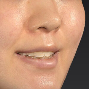 新宿ラクル美容外科クリニック　山本厚志　「猫手術（鼻唇角形成術）+ 貴族手術（鼻翼基部プロテーゼ）」　手術前　３月２５日