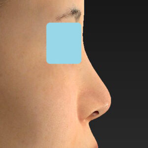 「耳介軟骨移植＋鼻尖縮小（close法）＋小鼻縮小+α」　新宿ラクル美容外科クリニック　２０代女性　手術前　３月２９日