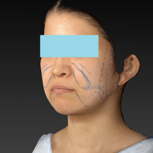 新宿ラクル美容外科クリニック　山本厚志　「ナチュラルフェイスリフト」「ライポライフ脂肪吸引（メーラーファット+ジョールファット）」　デザイン　３月２０日