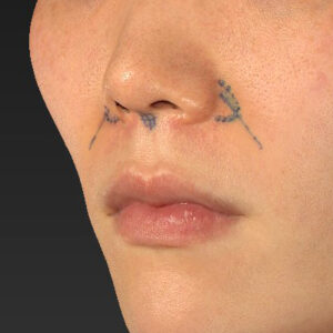 新宿ラクル美容外科クリニック　山本厚志　「猫手術（鼻唇角形成術）+ 貴族手術（鼻翼基部プロテーゼ）」　デザイン　３月１日