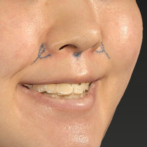 新宿ラクル美容外科クリニック　山本厚志　「猫手術（鼻唇角形成術）+ 貴族手術（鼻翼基部プロテーゼ）」　デザイン　３月２５日